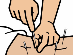 鍼刺入イラスト